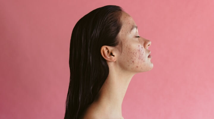 woman with adult acne