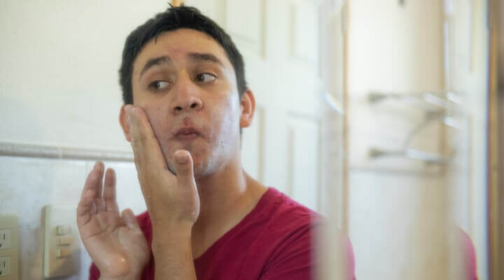 Handling acne flare ups