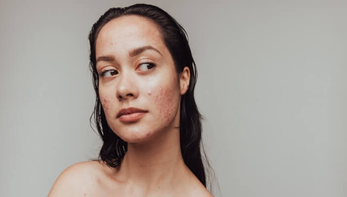 Acne-tips-derm)