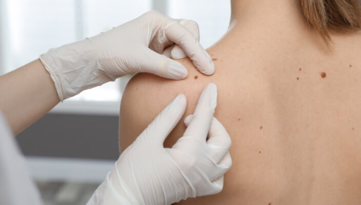 Skin Tags: Symptoms and Treatment | The Skin Surgery Center