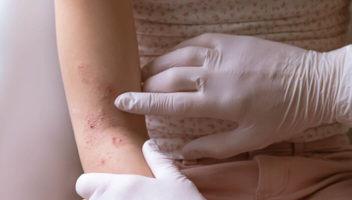 Examining rash