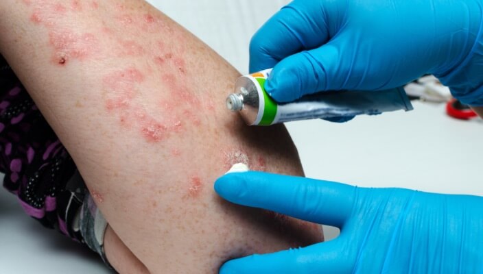 putting cream on poison ivy