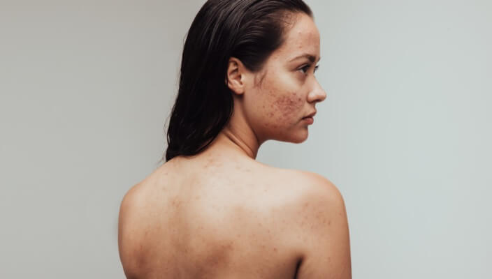 understanding adult acne)