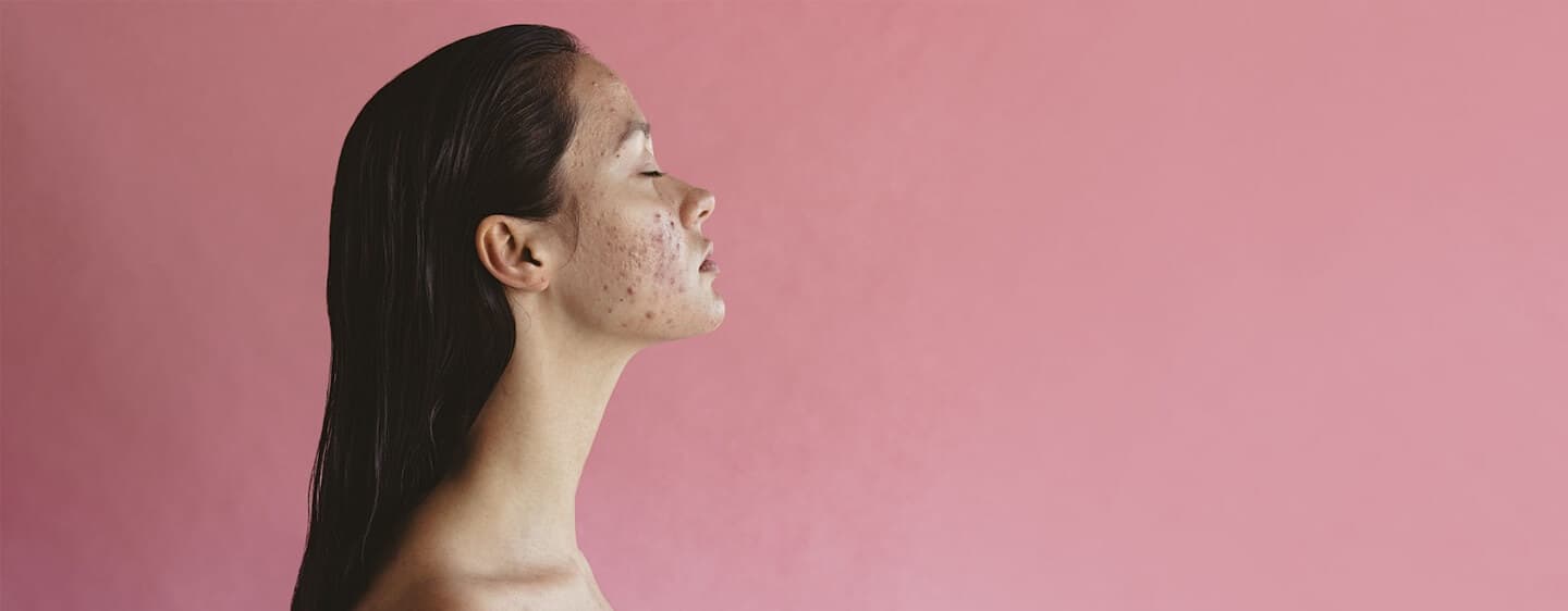 Skin Surgery Center Blog Hero - Acne and Aging: Why You Might Still Get Breakouts in Your 30s, 40s, and 50s