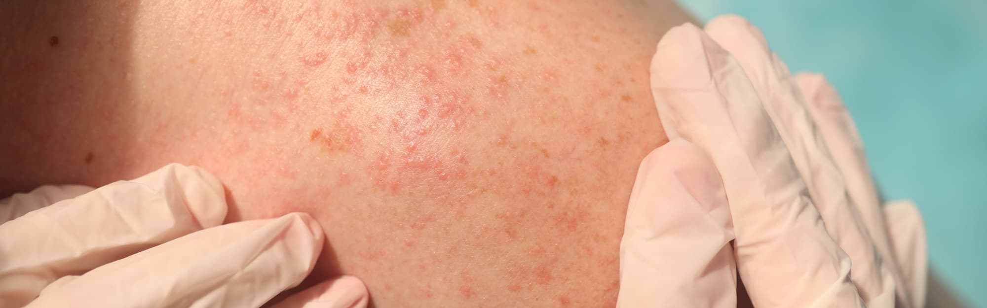Skin Surgery Center Blog Hero - Seasonal Changes and Poison Ivy Rash