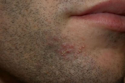 folliculitis3