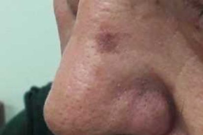 actinic-keratosis-1