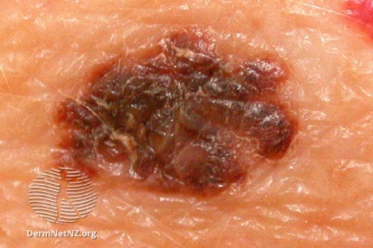 Skin-Cancer-3