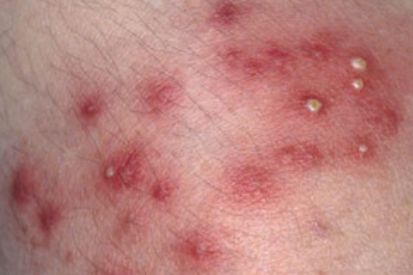 folliculitis5