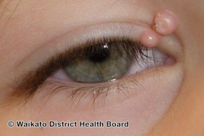 molluscum-contagiosum-eyelid-WatermarkedWyJXYXRlcm1hcmtlZCJd-1